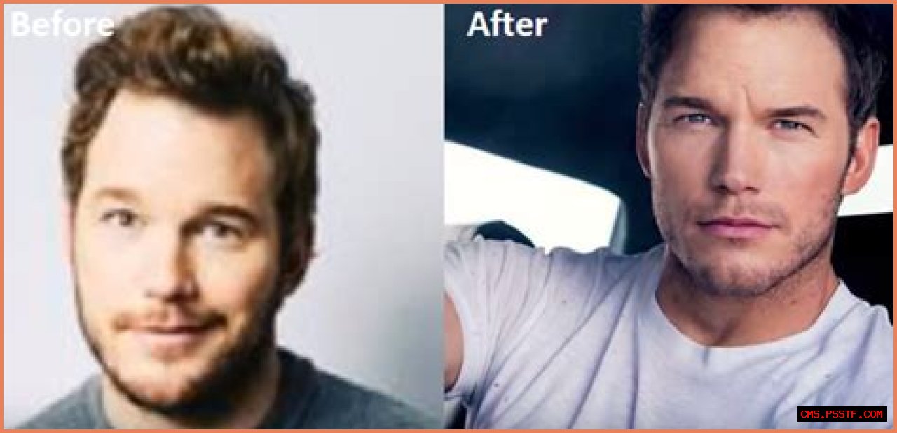 Chris Pratt Plastic Surgery Before and After